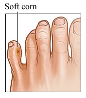 home remedies for soft corns