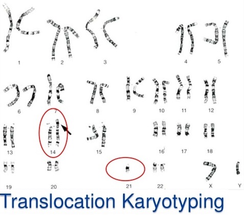 down syndrome karyotype translocation