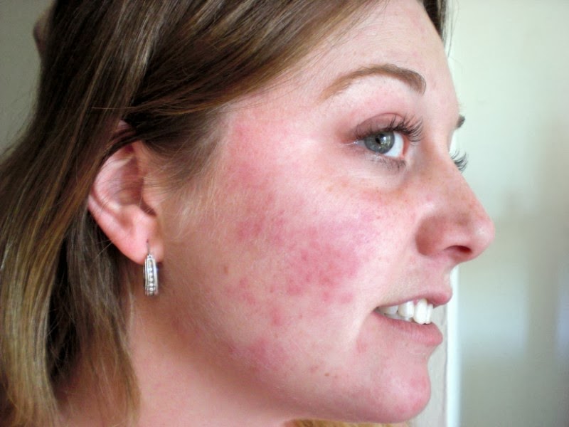 mild allergic reaction on face