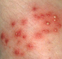 minor staphylococcus infection